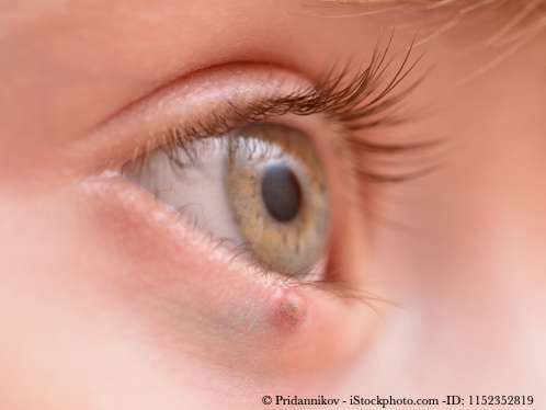 Bild von Hagelkorn und Gerstenkorn – Druck und Schmerz im Auge